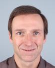 After Hair Transplant &nbsp;Front
